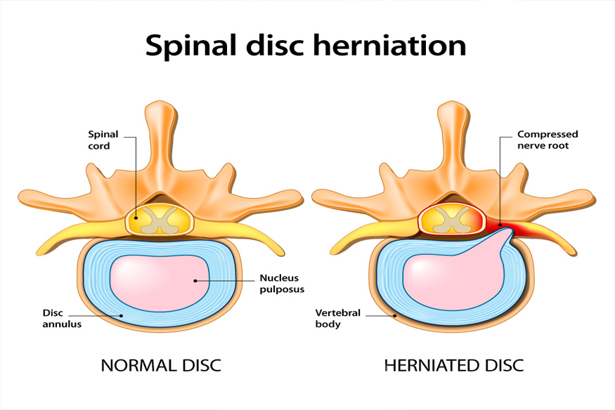 Spinal Decompression | Debary Chiropractor | Ultimate Spine